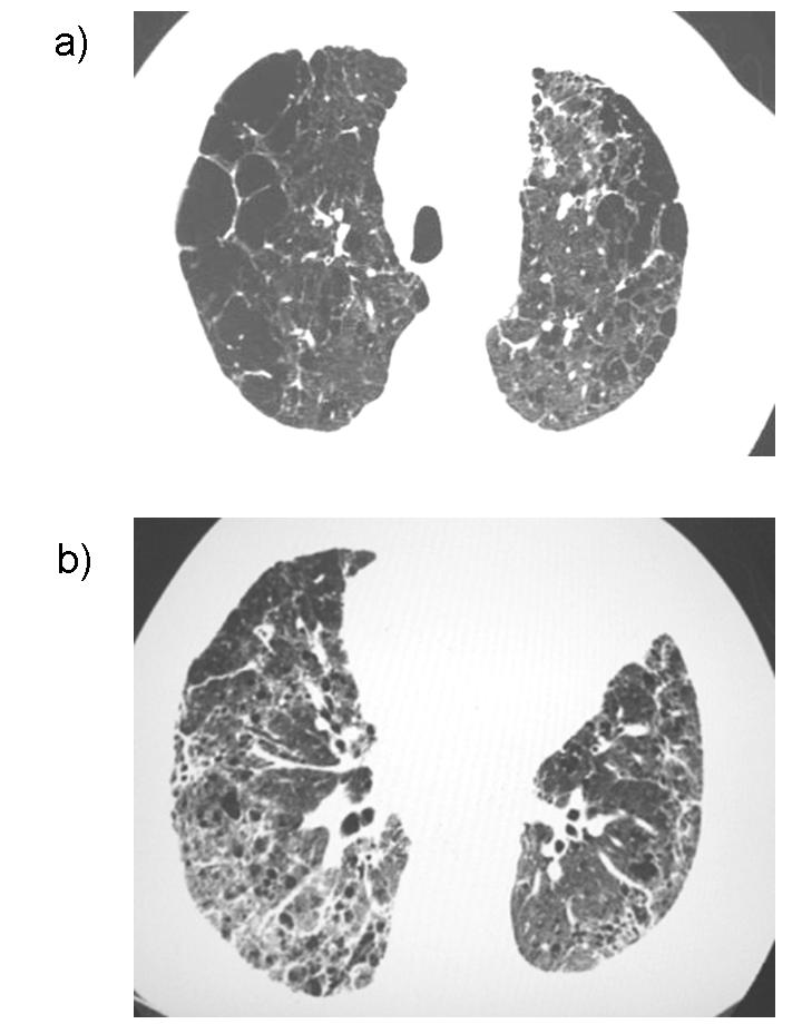 80 Emphysema patients and paraseptal emphysema in 11 of 31 patients (35%).