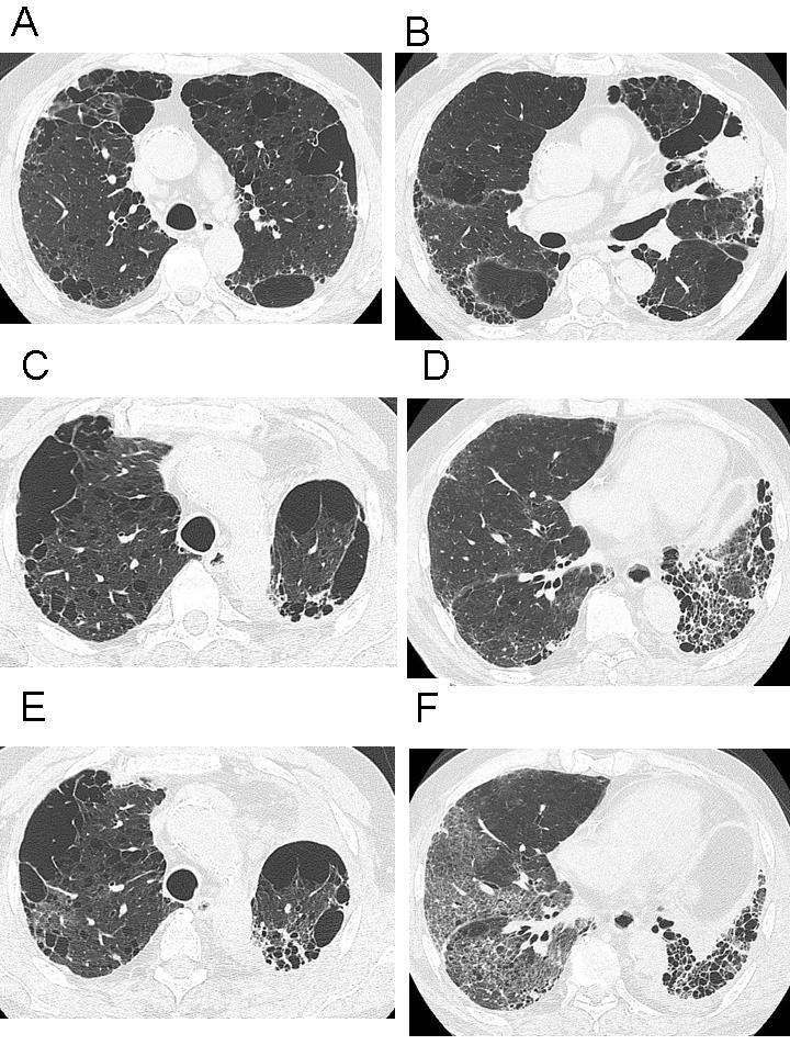 Combined Pulmonary Fibrosis and Emphysema (CPFE) 85 According to a clinical study of IPF based on autopsy studies in elderly patients performed in Japan, lung cancer developed in approximately 23% of