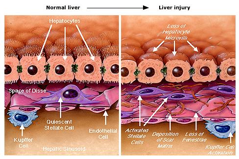 Changes in the subendothelial space of Disse and sinusoid as fibrosis develops in response to liver injury include alterations in both cellular responses and extracellular matrix composition.