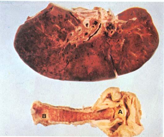 INFLUENZA Influenzaappearance of trachea and lungs.