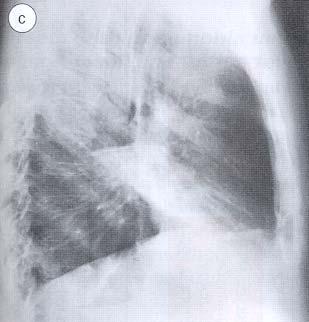 INFLUENZA Interstitial pneumonia due to influenza virus.
