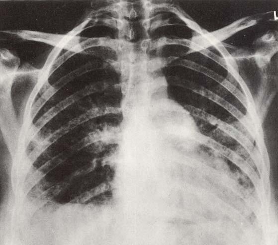 INFLUENZA VIRUS Another radiological appearance of viral interstitial