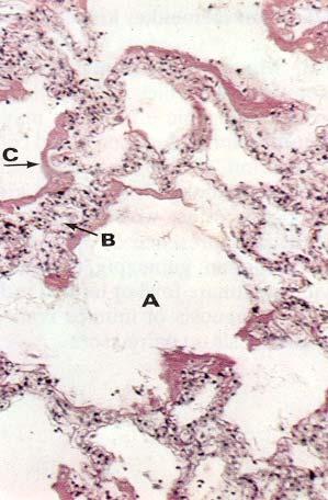 INFLUENZA VIRUS Section of lung in influenza.