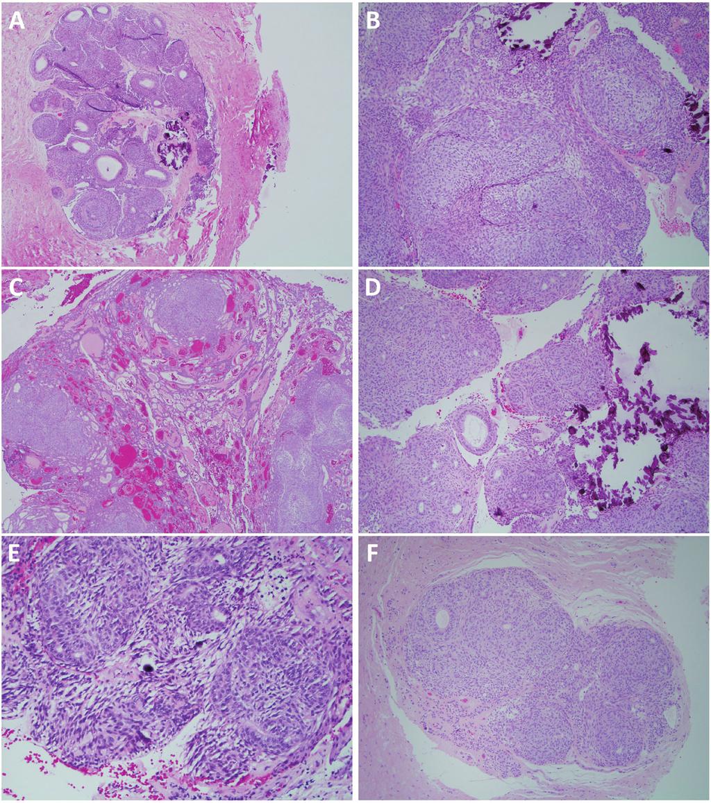 J Clin Exp Dent. 2017;9(11):e1315-21. Fig. 3: Histological features of all 14 AOT cases.