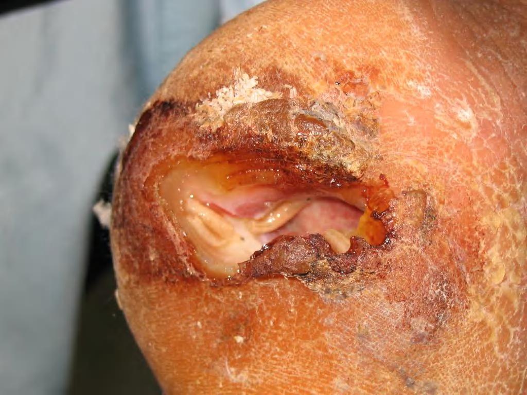 Infected wound in heel of