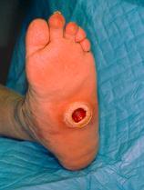 Treatment of Diabetic Foot Ulcers Until 1922