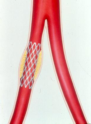 Stent Placement