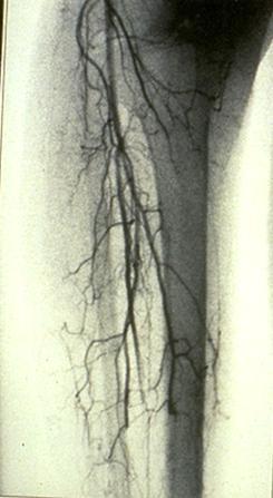 Therapeutic Angiogenesis for Peripheral Arterial Disease Example: