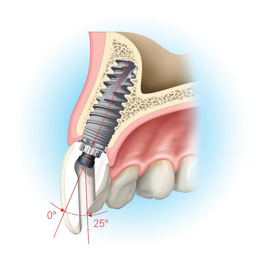 NobelProcera Angulated Screw Channel Correction (ASC) What is NobelProcera ASC?