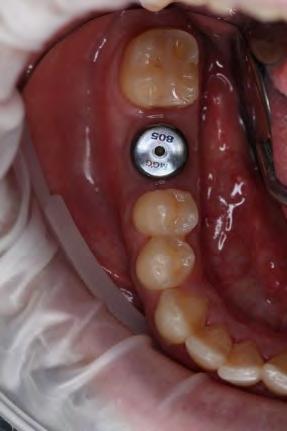 screw-retained, implant-supported restoration with the AnyRidge ZrGen Abutment (C-type).