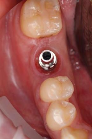 The patient presented with the healing abutment in place, and is ready to begin the restorative process eight