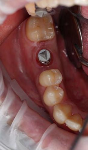 Removal of the healing abutment reveals healthy keratinized tissue and exposes the implant in preparation for