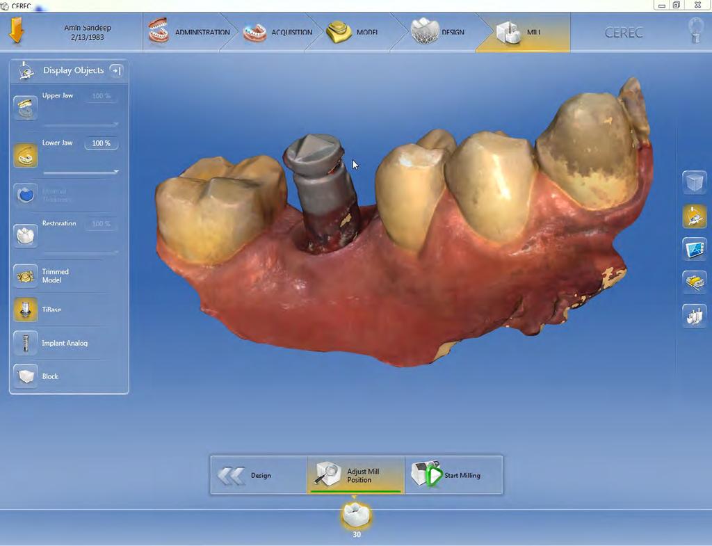 Fig 8: Intraoral Scan with CEREC Omnicam with 4.4.2 Software release. Axial View Fig 9: Intraoral Scan with CEREC Omnicam with 4.4.2 Software release. Buccal View Fig 10: Intraoral Scan with CEREC Omnicam with 4.