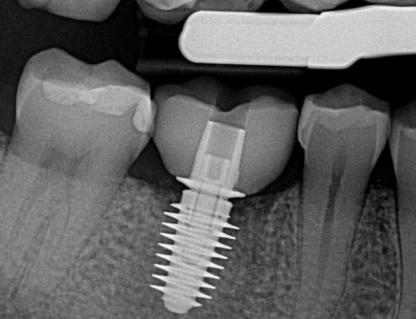 from CEREC. Note: NOT Properly Seated!