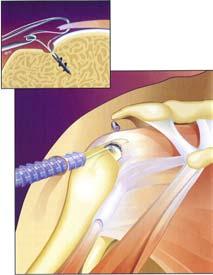 Coracoacromial Ligament Rotator Cuff Provides