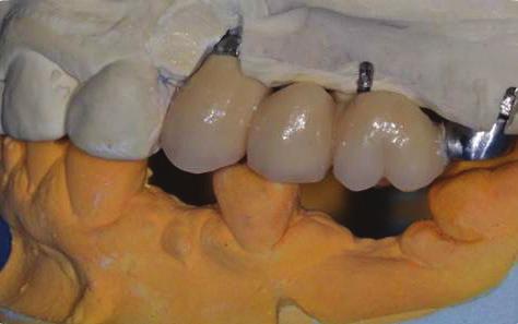A 5x 6 mm ATID implant was inserted