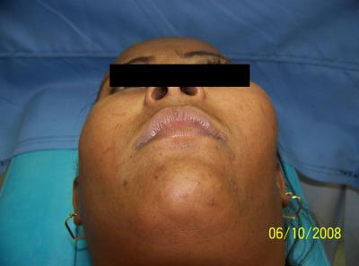 submandibular approach. A coronoid osteotomy was performed as well as a smoothing of the zygoma.
