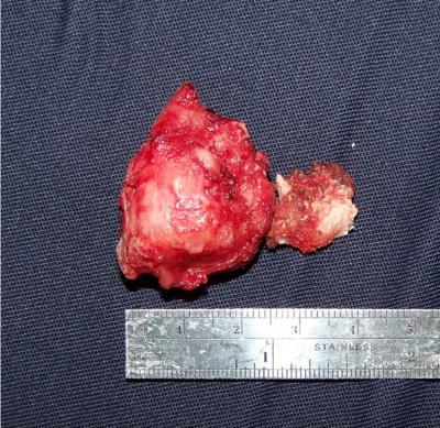 The coronoid process was resected at the level of the sigmoid notch so as to remove the entire tumor. Figure 4 Figure 2 Fig.