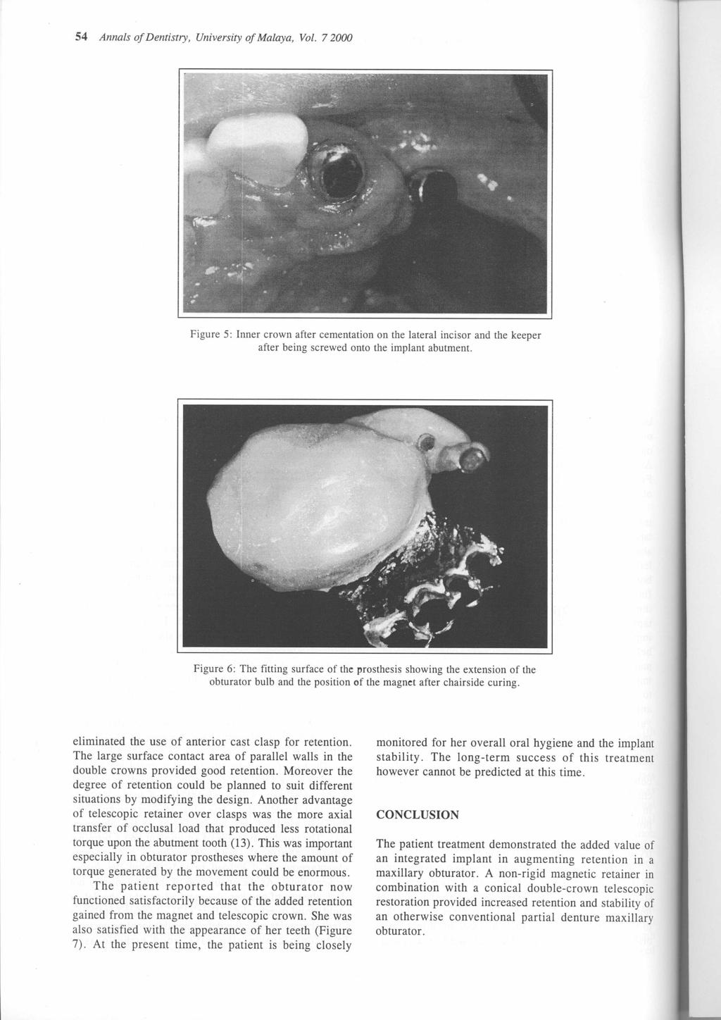 54 Annals of Dentistry, University of Malaya, Vol. 72000 Figure 5: Inner crown after cementation on the lateral incisor and the keeper after being screwed onto the implant abutment.