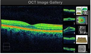 worsening or getting worse. This provides a very useful "second opinion" for your doctor in making this assessment. Optical Coherence Tomography (OCT).