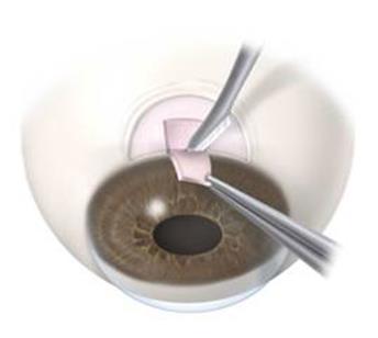 Laser Treatments for Narrow-Angle Glaucoma Laser peripheral iridotomy (LPI) reduces excessive intraocular pressure by making a small hole in the iris, the colored part of the eye.