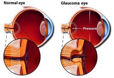 GLAUCOMA The Sneak Thief of your vision Nirmals Eye Hospital 108/5, Ayyasamy Street, Opp.
