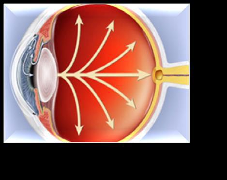 WHAT IS GLAUCOMA? Glaucoma is a group of eye diseases in which the pressure of fluid within the eye gradually increases to a level not tolerated by the sensitive tissues of the eye.