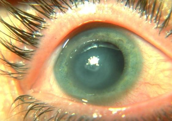 ACUTE CORNEAL DISORDERS: SYMPTOMS Eye pain