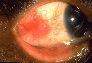 (steroid-induced glaucoma) Cataract formation and progression Potentiate