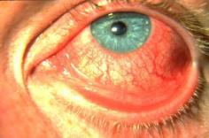 Summary COMMON RED EYE DISORDERS: TREATMENT INDICATED Hordeolum Chalazion Blepharitis Conjunctivitis Subconjunctival hemorrhage Dry eyes Corneal abrasions (most) Summary VISION-THREATENING RED EYE