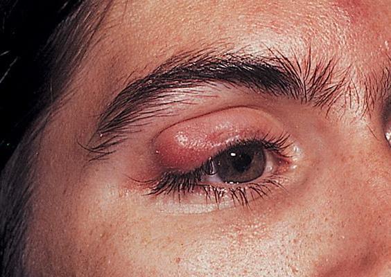 Eyelid lesions Stye Chalazion: A painless (usually, but acutely painfull),