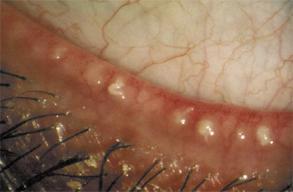 Seborrhea causes dried skin and wax on base of lashes May have Staphylococcal