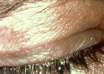 Probably most common cause of chronic eye irritation Inadequate quantity and/or