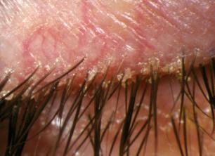 Blepharitis and Meibomian Gland Dysfunction These are very commonly seen together (anterior + posterior blepharitis) and treatment is similar and