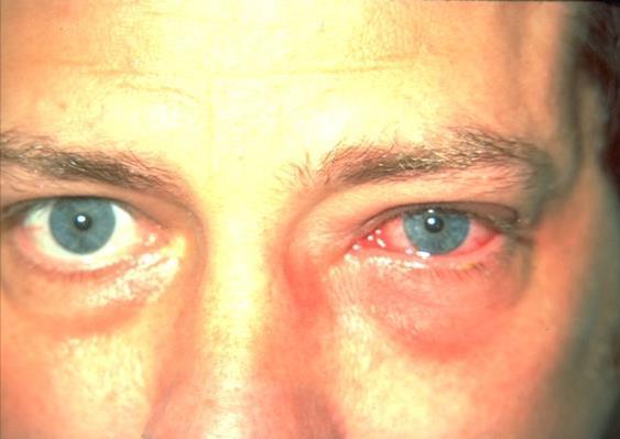 VIRAL CONJUNCTIVITIS Watery discharge Highly contagious Palpable preauricular