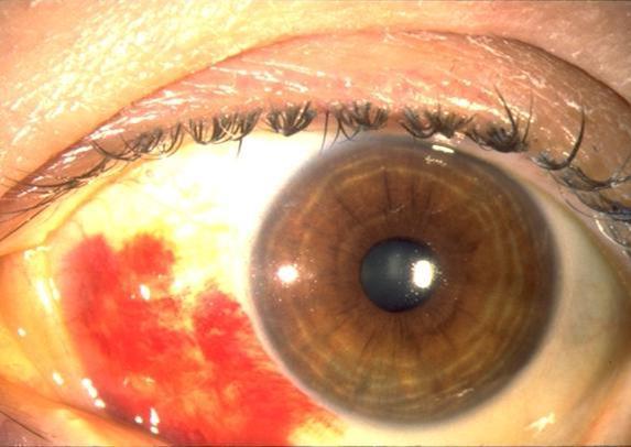 Subconjunctival hemorrhage TEAR DEFICIENCY STATES: SYMPTOMS Burning Foreign-body sensation Paradoxical reflex tearing Symptoms can be made worse by reading, computer use, television,