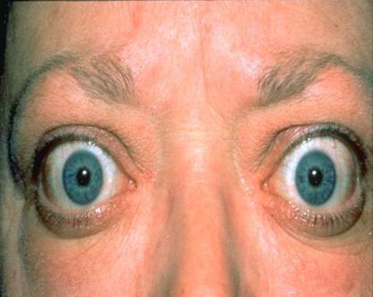 eyelids Counseling about activities that make dry eyes worse