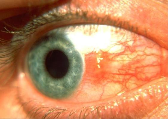 EXPOSURE KERATITIS: CAUSES AND MANAGEMENT Due to incomplete lid