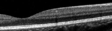 Retinal Layers with RTVue