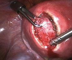 She later returned with increased bleeding and had hysteroscopic resection of a