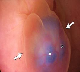 laser or cautery Cystoscopy if bladder lesion Hysterectomy +/- oophorectomies Oophorectomies Patient asks