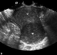 Case 3- Priorities? Ultrasound Diagnosis Stop bleeding Improve pain Leave uterus in situ for possible pregnancy in future How will we do these things?