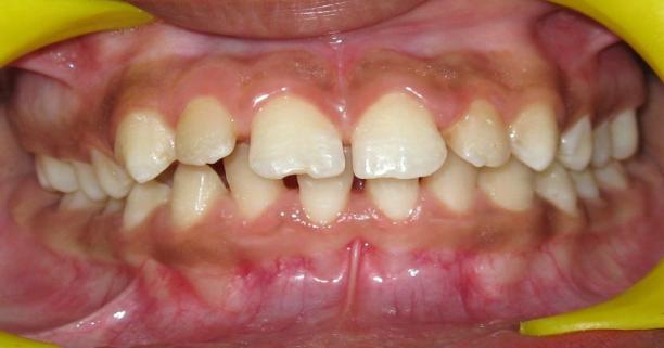 J Clin Periodontol 2004; 31: 736-741. [16] Bosnjak A, Relja T, Vucicevic-Boras V, Plasaj H, Plancak D. Pre-term delivery and periodontal disease:a case-control study from Croatia.