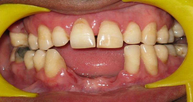 6 showing healthy periodontium after non surgical therapy.