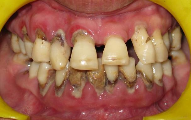 8 showing healthy periodontium after non surgical therapy. Table.1.