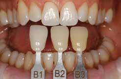 Paste Practical Procedure Shade determination tooth shade, stump shade Shade determination of the natural tooth.