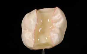 This measure helps to reduce premature discolouration between the restoration margins and tooth structure.