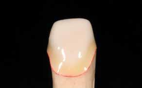 Procedure for non-vital, discoloured stumps Mask the entire die with Liner to block out the dark colour of the underlying tooth stratum and, at the same time, to attain an adequate degree of
