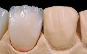 Reproduce areas of higher brightness with Opal Effect 3 (cervical). Apply the appropriate Transpa materials to the dentin core.