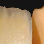 It is recommended to build up the veneer segment by segment (tooth by tooth), to separate them from each